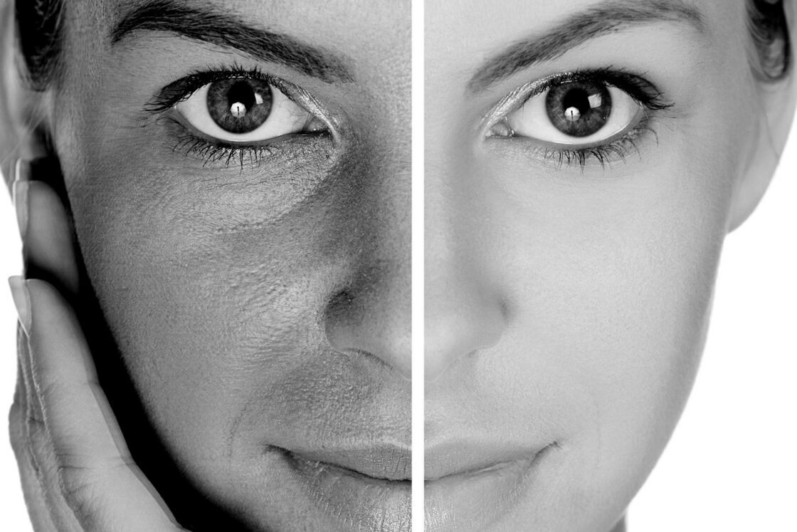 Microagulhamento com PDRN e Exossomos