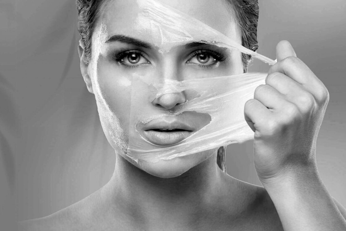 Peeling Químico